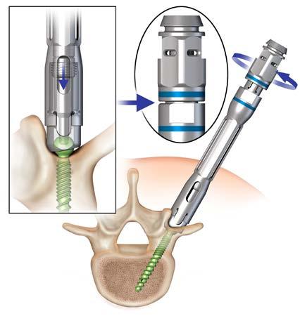 provides a fenestrated screw shank will accommodated the delivery of cement. Reference the prior surgical steps above for pedicle preparation and screw insertion.