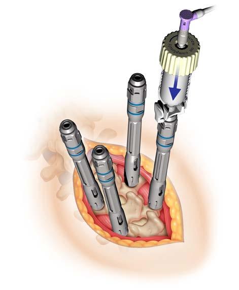 SUBSEQUENT LEVEL AUGMENTATION Place the existing cannula and cement reservoir into the next alignment guide and repeat the procedure described above.