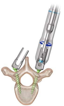 1,2,11 The EXPEDIUM VERSE Spinal System provides extended tabs with 17mm of reduction.