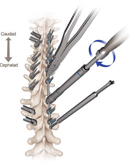 T-Handle Following rod capture and prior to rod reduction, typically the sagittal contour of the rod is still in the coronal plane.