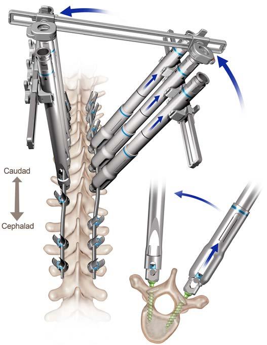 An assistant pushes down on the convex ribs and the convex screws, while the concave levels are rotated in the direction that will reduce the rib prominence.