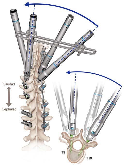 Segmental Vertebral Body Derotation with the EXPEDIUM VERSE System Segmental Vertebral Body Derotation can be done as the sole derotation maneuver or in addition to the en bloc maneuver described