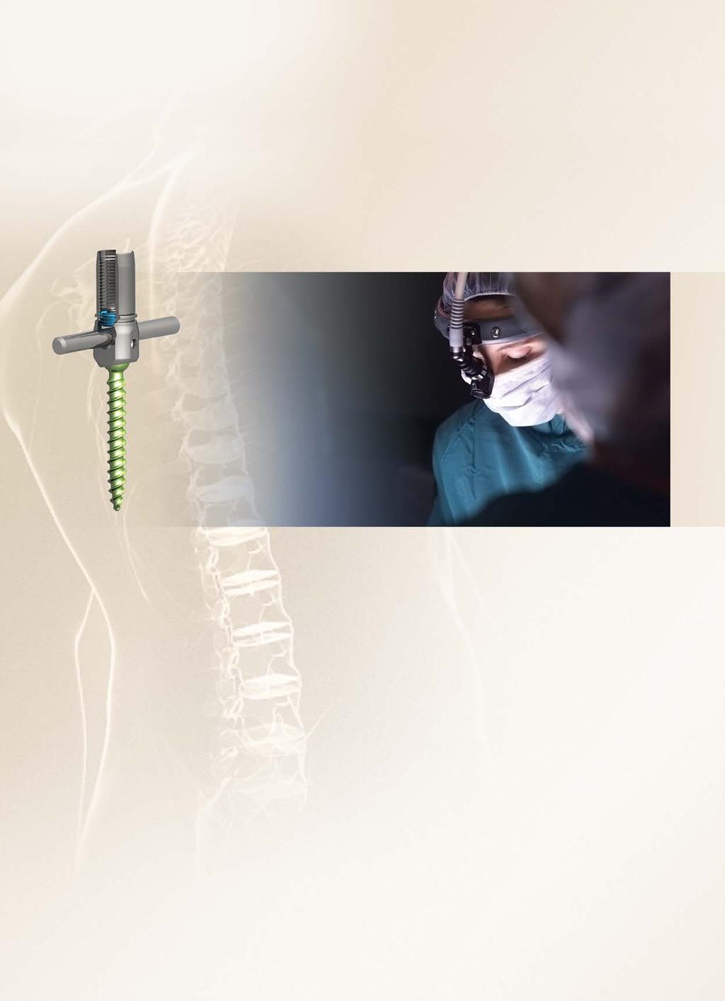 1. PRODUCT OVERVIEW The EXPEDIUM VERSE SPINAL SYSTEM has two configurations. The first configuration utilizes the classic solid shank, double lead threadform found on Expedium 5.