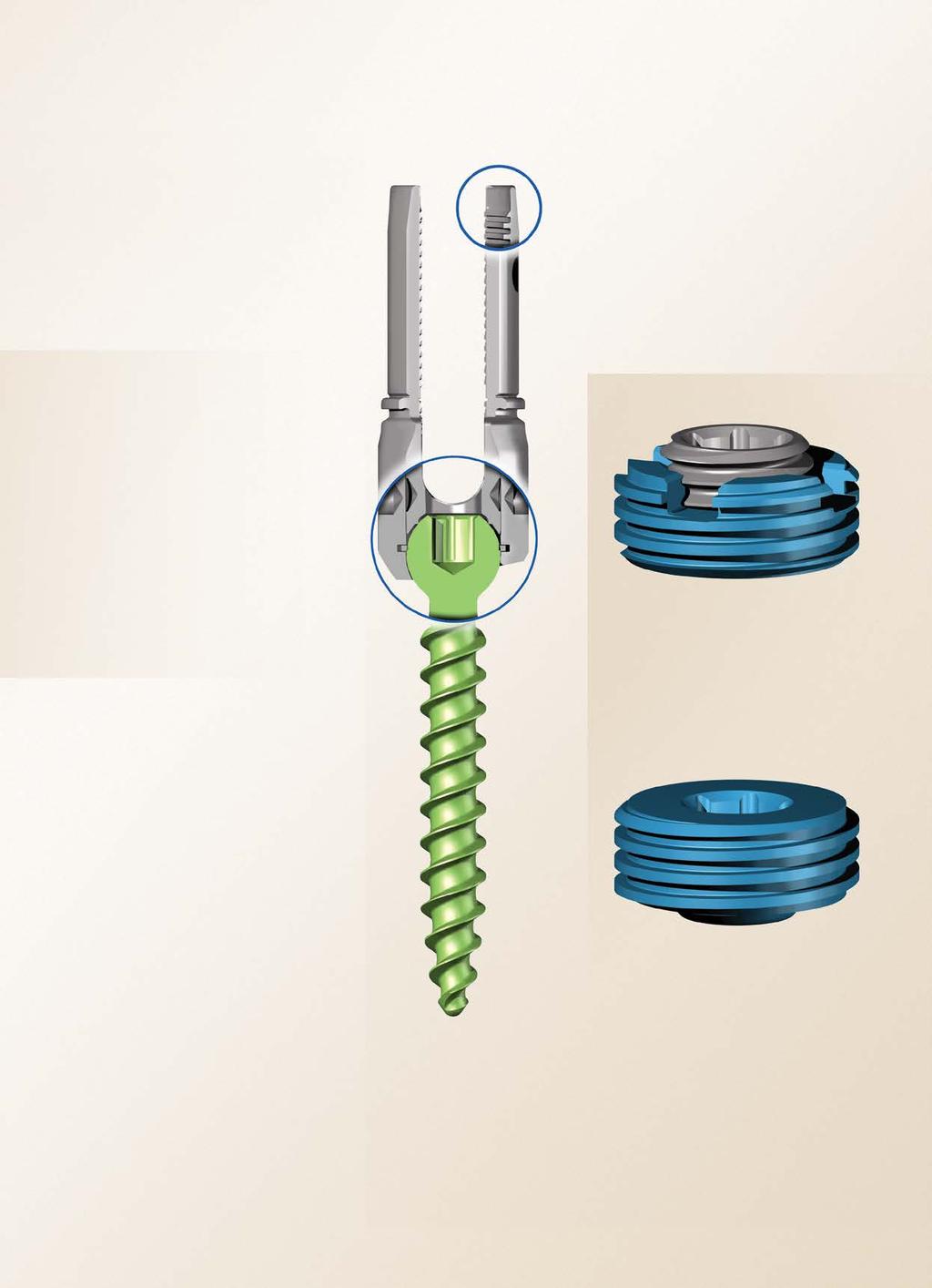EXPEDIUM VERSE Polyaxial Pedicle Screw TOP NOTCH Feature The Top Notch Feature helps various instruments easily connect to the implant and simplifies intraoperative maneuvers.