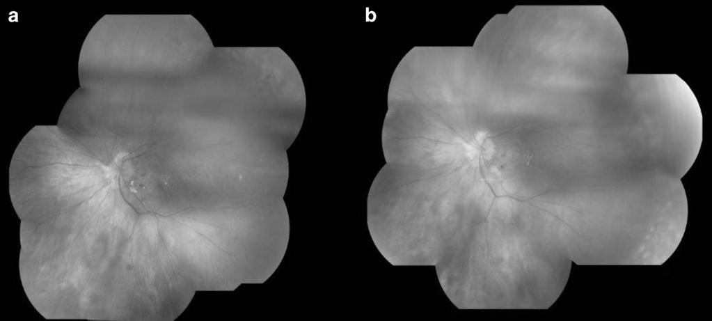 1294 Management of giant retinal tears Figure 2 Fundus pictures taken at day 1 post vitrectomy and tamponade with PFO and day 7 before PFO removal (a and b, respectively), and showing the absence of
