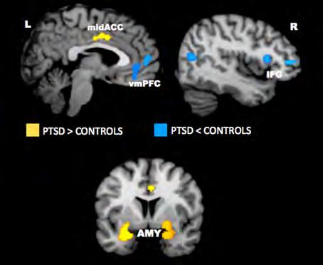 Functional Neuroimaging in PTSD: Negative Emotional States Hyperactivation Hypoactivation AMY: Amygdala IFG: