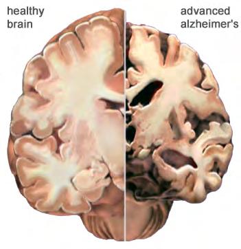 The Alzheimer s Brain: Gross Anatomical Changes Ø The cortex shrivels up, damaging