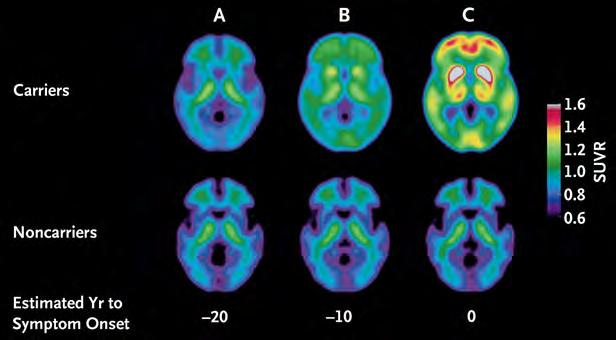 Predicting Alzheimer's Disease: Biomarkers Brain scans show evidence of Alzheimer s disease 20 years before symptoms arise (far left), 10 years before (middle), and after the onset of symptoms