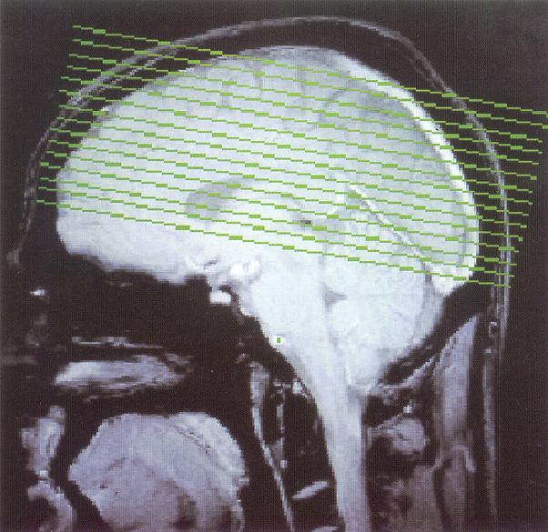 Fig. 1. Slice orientation parallel to bicommissural plane. The block of 15 slices covers the whole motor cortex.