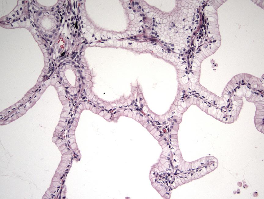 76 Chirieac & Dacic Fig. 5. Broncholoalveolar mucinous adenocarcinoma (mucinous BAC) is exclusively TTF-1 negative and EGFR mutation negative, but may have KRAS mutation (H & E, 200). risk.