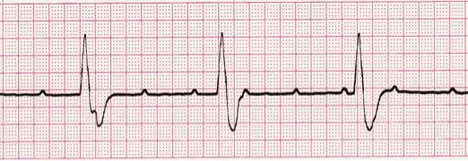 are constant PR is constant Dropped QRS Wide