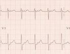 Ask the following questions:- 1. Is it a narrow or broad QRS? 2. Is it regular or irregular? 3.