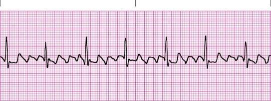 Narrow Complex Tachycardia s We can now divide our narrow complex tachycardias into two groups 1.