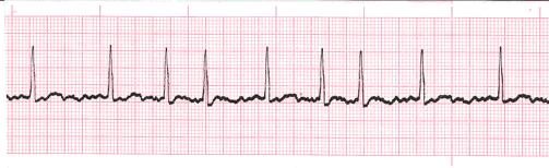 P waves may be hidden or follow QRS c. Atrial Flutter i.