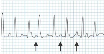i. P waves are present, but with 3 or more morphologies Wide Complex Tachycardia s 1. Ventricular Tachycardia a.