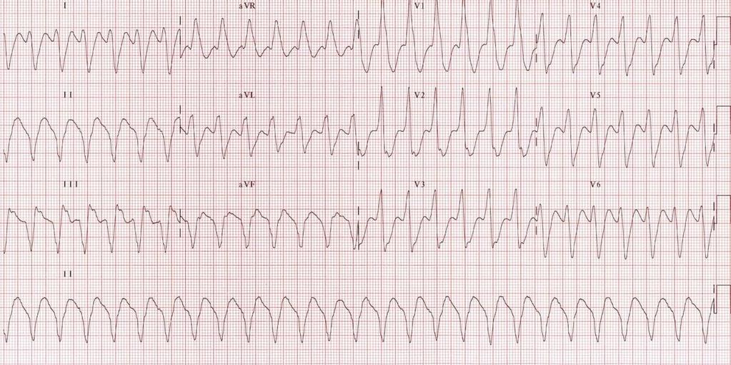 Clinical correlation is always reliable 2. VT Mimics a. If rate is less than 120 beats per minute, consider:- i. Hyperkalaemia ii.