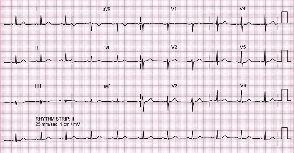12 Lead ECG How to start What is the rate o Look at the ventricular rate Count number of big boxes between R-R interval and divide this into 300.