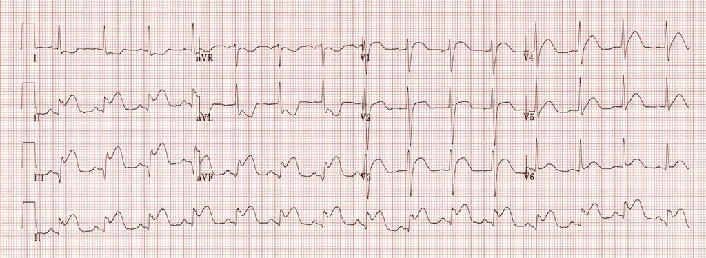 o Identify its morphology o Is it upright or inverted ECG and ischaemic patterns A.