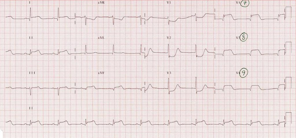 C. Posterior AMI ECG and ischaemic patterns Changes to V1-V3 Horizontal ST depression Tall, broad R waves Upright T waves Dominant R waves in V2 Do posterior