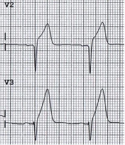 ECG and ischaemic patterns The following are important patterns to recognise as part of potential