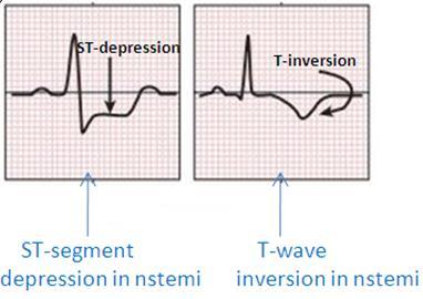 Hyperacute T-waves Can be early sign of infarction Tall, peaked, asymmetrical Broad base B.