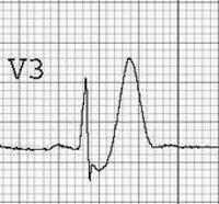5mm at 2 or more contiguous lead T wave inversion occurs at 2 or more contiguous leads and