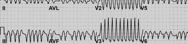 Case 38 year old male with recurrent rapid palpitations and history of syncope as a teen. BP 109/70. The following EKG is obtained: What is the next best step: 1. Load with IV digoxin 2.