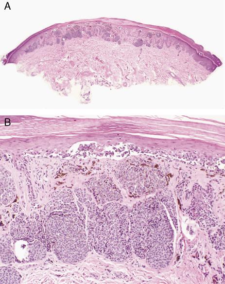 Adv Anat Pathol Volume 17, Number 2, March 2010 FIGURE 2. Traumatized compound nevus of acral skin with atypical features.