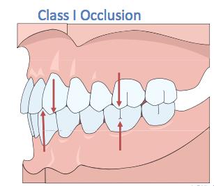 »Classification of Occlusion For many years the standard for classification of occlusion has been Angle s classification of malocclusion.