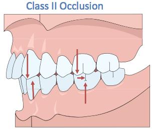 the last molars are distal to the other teeth in the arch. Angle class II and III Maxillary teeth are more mesial, whereas in class III mandibular teeth are more mesial.