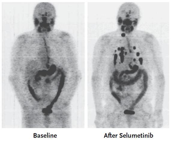 I-131: The SELIMETRY Study Multi-centre trial in the UK assessing the efficacy of selumetinib followed by radioiodine in iodine refractory thyroid cancer.