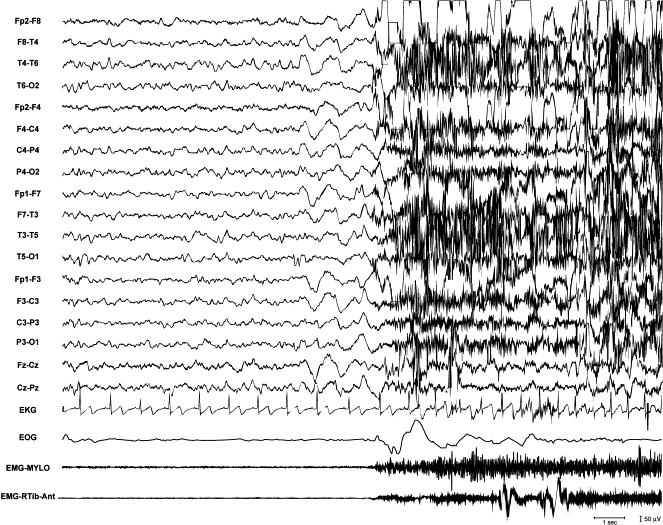 ONSET OF NIGHT TERROR - EEG Spontaneous attack during stage 3 of NREM sleep Increased heart rate (shown from EKG) A spontaneous attack during NREM was recorded.