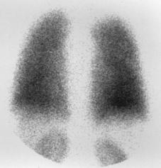 A B Figure 3. Technetium 99m macroaggregated albumin scanning reveals A) normal uptake of the radionuclide in the lungs.