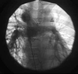 Pulmonary arterio-venous fistulas Pulmonary arterio-venous fistulas No conflicts of interest to declare Julien I.E.