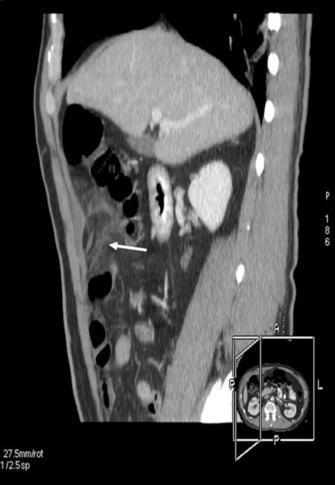 Right-sided epiploic appendagitis Figure 1 Adjacent to the ascending colon there is a fat density mass with a high density center (corresponding to the thrombosed vein) and is surrounded by the high