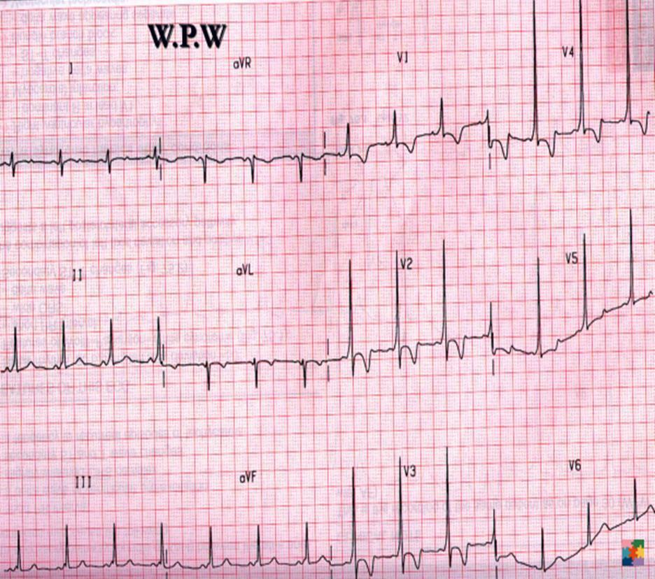 Clues in sinus rhythm No Q in Lt chest leads (WPW 88%, control 5%) PR < 100msec (WPW 80%, control 16%)