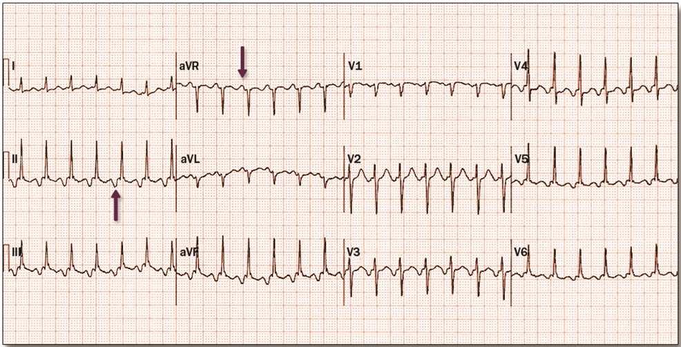slow atrioventricular node pathway, followed by retrograde conduction in a fast atrioventricular node pathway. Typical AVNRT is a type of short RP tachycardia.