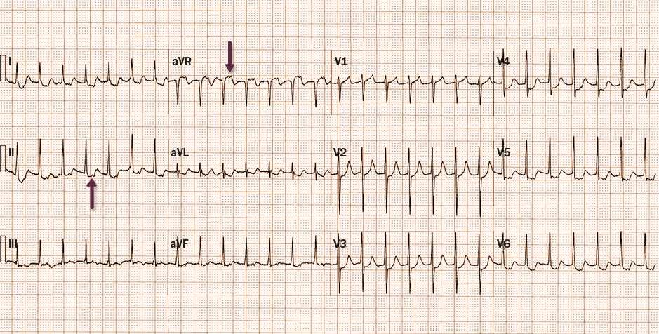 Figure 4. Orthodromic Atrioventricular Reentrant Tachycardia Arrows point to the P waves, which are inscribed in the ST segment after the QRS complex.