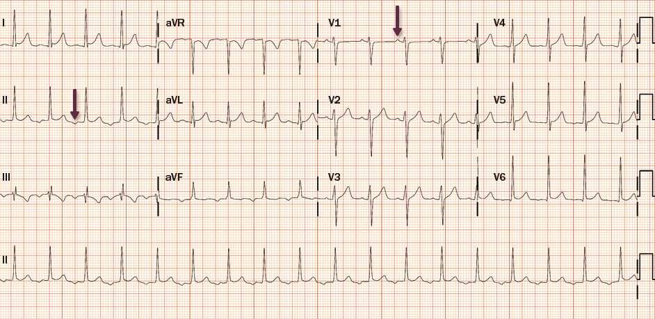 retrograde P wave with short RP interval. Figure 5. Atrial Tachycardia Arrows point to the P wave, which is inscribed before the QRS complex.