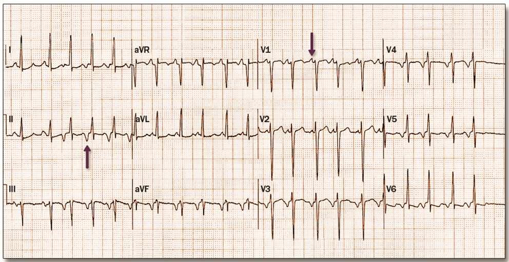 Tachycardia starts after 2 beats of sinus rhythm. Arrows point to the P wave, which is inscribed before the QRS complex.