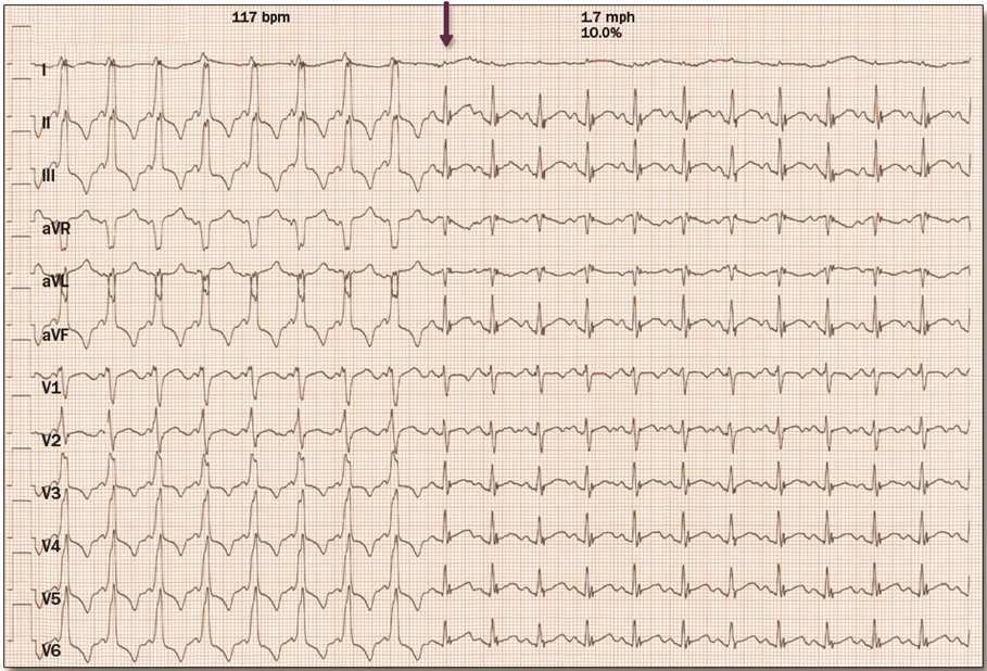 Figure 16. Abrupt Loss of Pre-Excitation During Exercise Testing During exercise treadmill testing, this patient abruptly lost pre-excitation at a heart rate of 117 bpm.