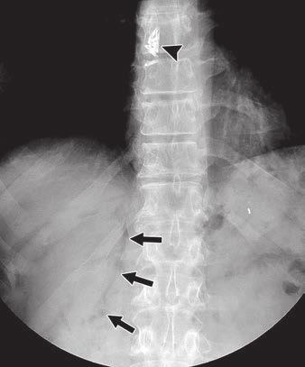 closure of mucosal incision in esophagus and one clip (small arrow) that migrated into stomach. Pneumoperitoneum (arrowhead) is also shown beneath right hemidiaphragm.