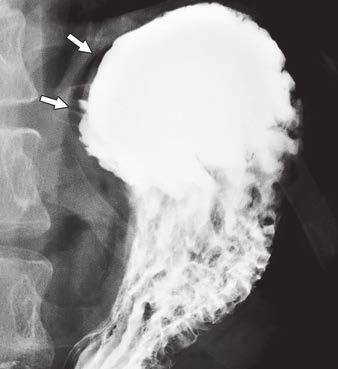hemidiaphragm. Gas (black arrow) is shown in wall of proximal stomach. One endoscopic clip (arrowhead) has migrated into stomach.
