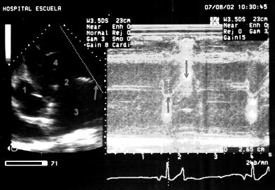 Panel B depicats aorta (1), parietal leaflet of mitral valve (2), left atrium (3), left ventricle (4), Mitral annulus, parietal portion (arrow).