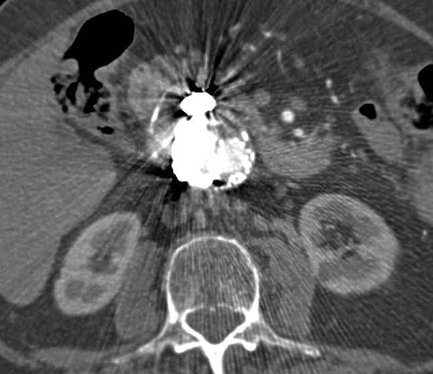 injection with contrast seen filling the sac