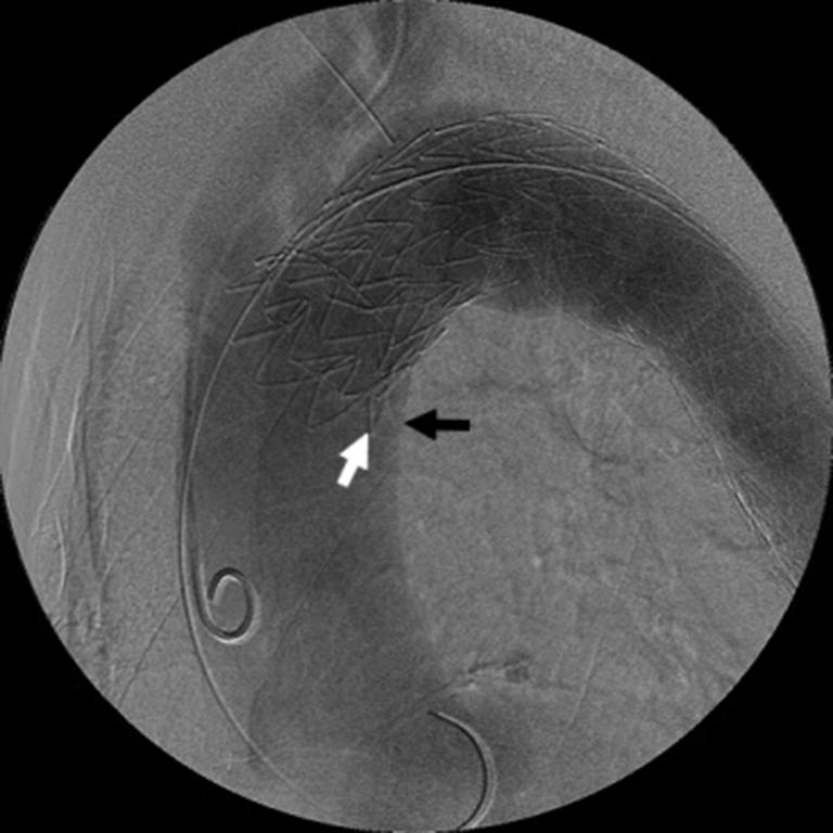 endoleak (arrows). EVAR, endovascular aneurysm (or aortic) repair; DSA, digital subtraction angiography. Figure 9 Bird-beak configuration of TEVAR endograft.
