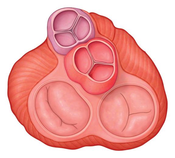 What Heart Valves Do Heart valves ope whe the heart pumps to allow blood to flow forward, ad close quickly betwee heartbeats to make sure blood does ot flow backward.