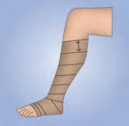 - Both the heel and the metatarsolphalangeal joints should be bandaged.