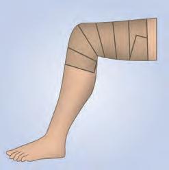 The compression bandage on the thigh is wrapped around the thigh as far as the proximal region thereof.
