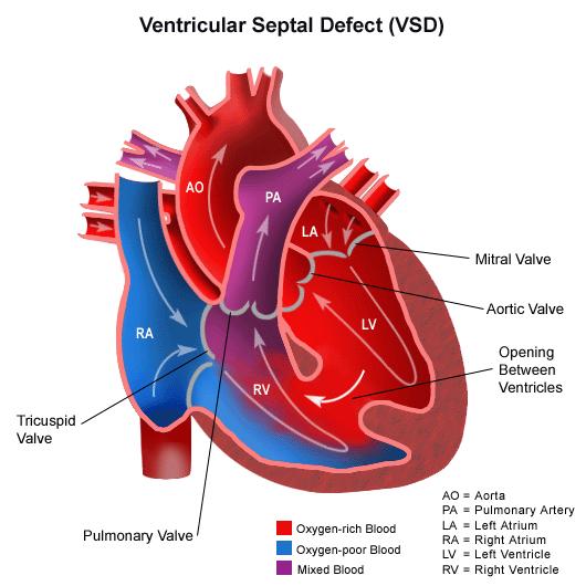 2) VSD & PDA - Dr. Aso Ventricular Septal Defect (VSD) Most common cardiac malformation 25-30 % Types of VSD: According to position perimembranous, inlet, muscular.
